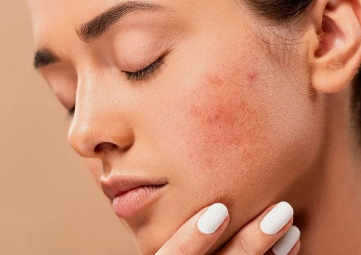 冬季皮肤敏感泛红是什么原因？2025年冬季敏感肌舒缓护理的实用方法