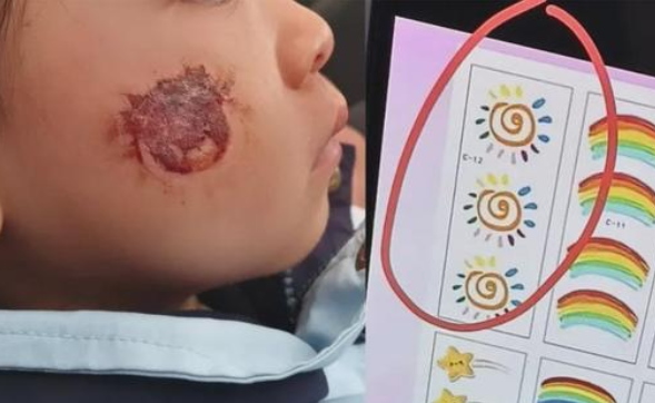 3岁女童脸部贴贴纸致皮肤糜烂，贴纸接触皮肤会造成严重的皮肤损伤