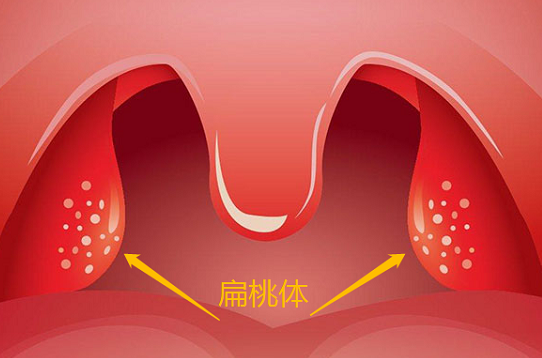 儿童冬季扁桃体发炎怎么办？2025扁桃体发炎预防与护理指南