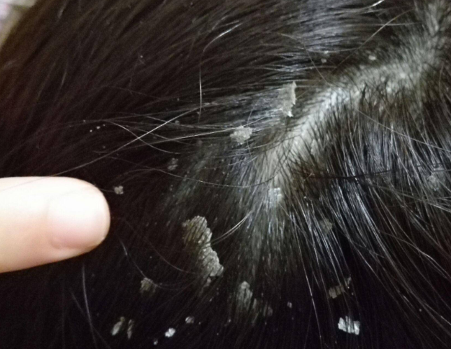 冬季头皮屑增多怎么办？2025控油去屑护理实用小技巧大全