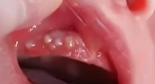 小月龄宝宝可以擦碘伏吗？小月龄宝宝擦碘伏有什么危害？