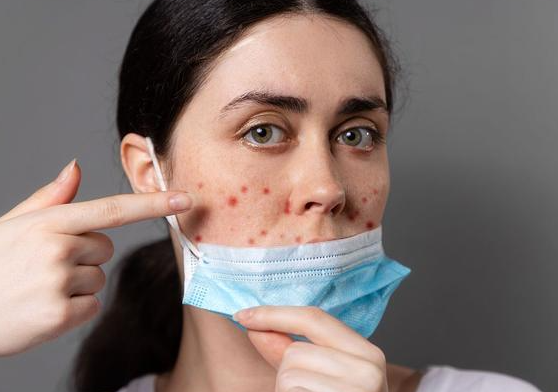 冬季戴口罩脸部闷痘怎么办？2026年透气型口罩选择指南