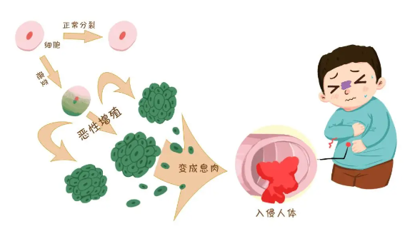 这种面相可能是肿瘤前兆 鼻唇增大下巴突出手脚变粗可能是垂体腺瘤前兆