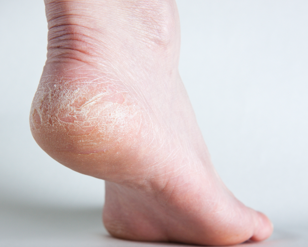 冬季痰湿体质容易导致皮肤干燥开裂吗?如何科学调理能养出水润肌?