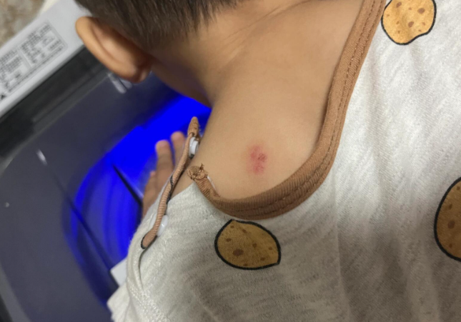 不小心被动物咬伤需要打破伤风吗?什么情况下被咬伤需要打破伤风? 不小心被动物咬伤需要打破伤风吗?什么情况下被咬伤需要打破伤风?