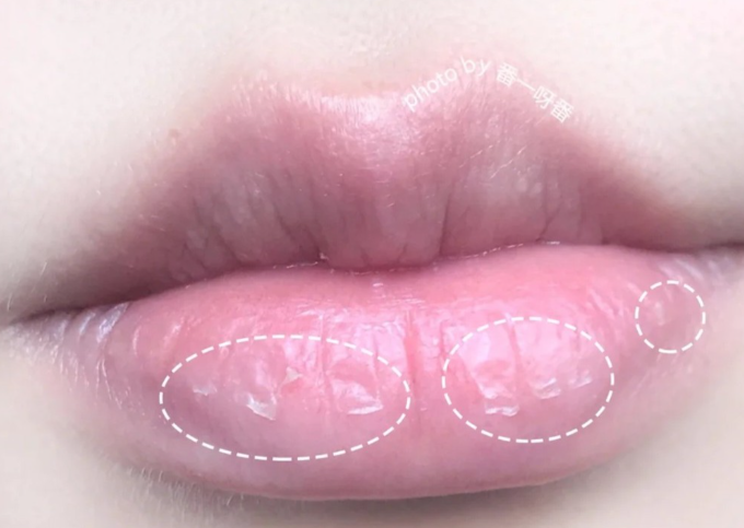 冬季唇炎反复难愈？2026冬季唇部护理成分避坑与修复指南