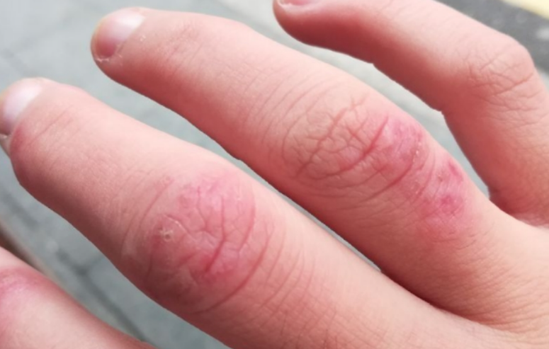 儿童冻疮红肿如何消肿？2026年手足冻疮消肿止痒处理方法