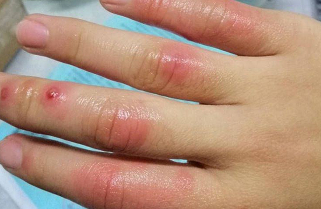 儿童冻疮红肿如何消肿？2026年手足冻疮消肿止痒处理方法