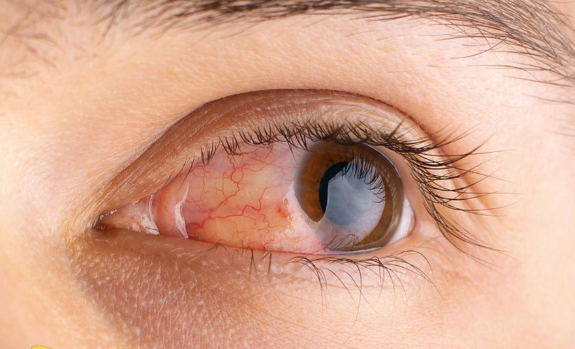 细菌性角膜炎的症状可能有哪些 患上细菌性角膜炎如何自救