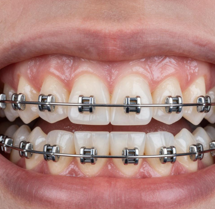 嘴巴凸戴牙套能改善吗？2026需要戴牙套人群