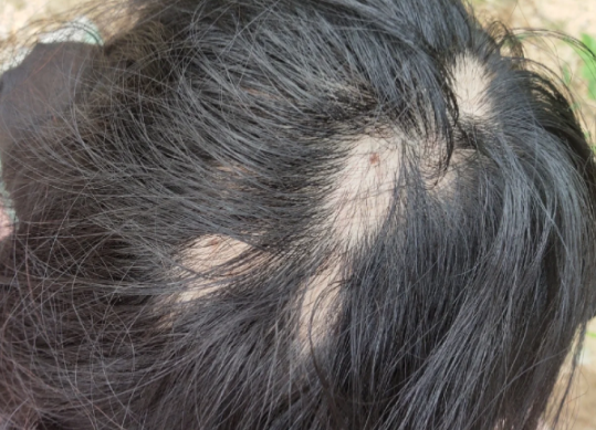 02年小伙长期熬夜成重度斑秃 为什么秃头现象越来越年轻化