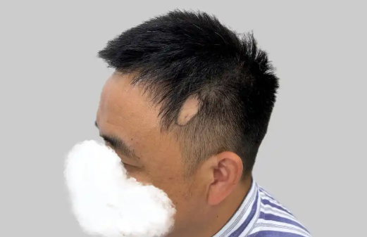 02年小伙长期熬夜成重度斑秃 为什么秃头现象越来越年轻化