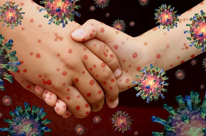 全球多个国家出现麻疹疫情反弹或暴发!开学季警惕麻疹疫情输入风险