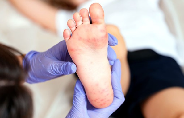 全球多个国家出现麻疹疫情反弹或暴发!开学季警惕麻疹疫情输入风险