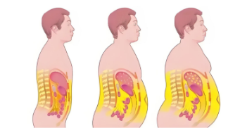 内脏脂肪是隐形炸弹？内脏脂肪可能是癌症推手
