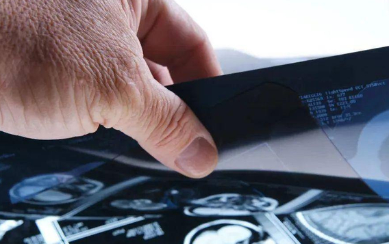 1.5元收一张旧CT片?千万别卖 非法提炼旧CT片污染环境危害健康