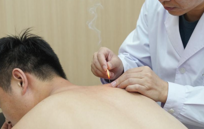火针疗法到底疼不疼？ 2026火针疗法先分清部位再看手法