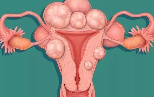子宫肌瘤的危害有哪些？如何及时发现并治疗子宫肌瘤？