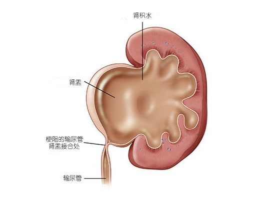 肾积水便是在众多肾炎中,较为普遍,也是会严重危害病人性命的病症.