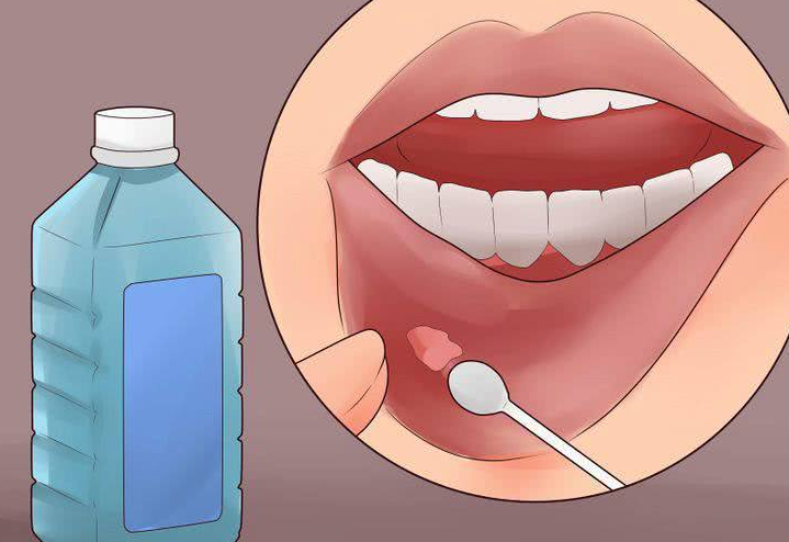 口腔溃疡上为什么有一层白色的膜口腔溃疡上的白膜可以揭掉吗