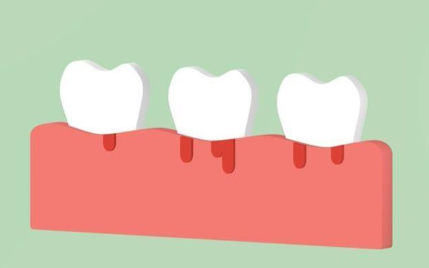 牙齒一吸就出血是癌症!不至於,但若是這3種,就不得不重視了