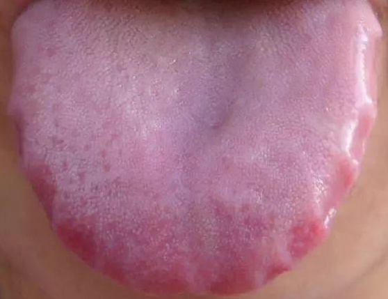舌头有齿痕是怎么回事?是身体哪里有问题吗?