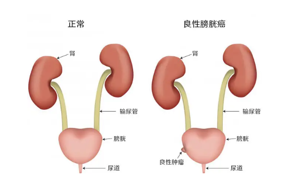 尿结石的症状|膀胱肿瘤如何治疗?  - 好医生在线
