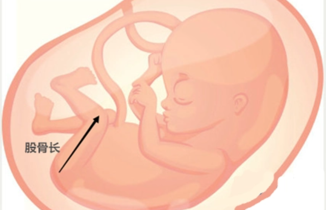 胎儿股骨短6周出生图片