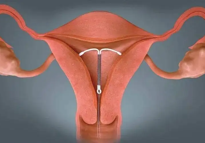 女性节育手术 节育环图片