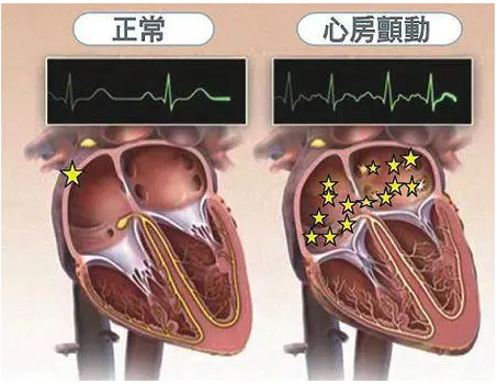 早春房颤患者如何做好心脏节律控制?2024房颤患者做好心脏节律控制要注意啥?