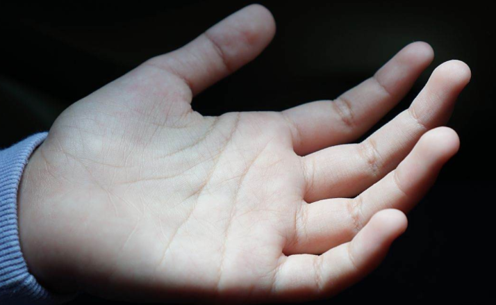 手指一冻会发白麻木竟是身体警报?手指冻发白可能是雷诺氏综合征 手指一冻会发白麻木竟是身体警报?手指冻发白可能是雷诺氏综合征