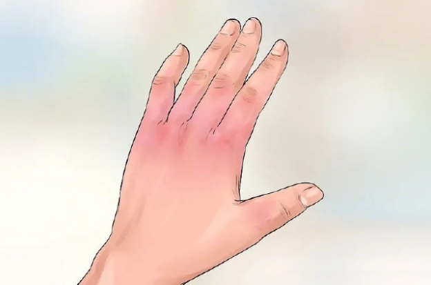 手指一冻会发白麻木竟是身体警报?手指冻发白可能是雷诺氏综合征 手指一冻会发白麻木竟是身体警报?手指冻发白可能是雷诺氏综合征